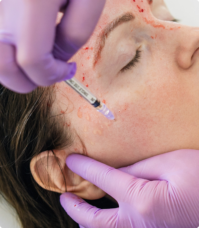 Vampire facial treatment being performed with PRP injection on a woman's face for skin rejuvenation.