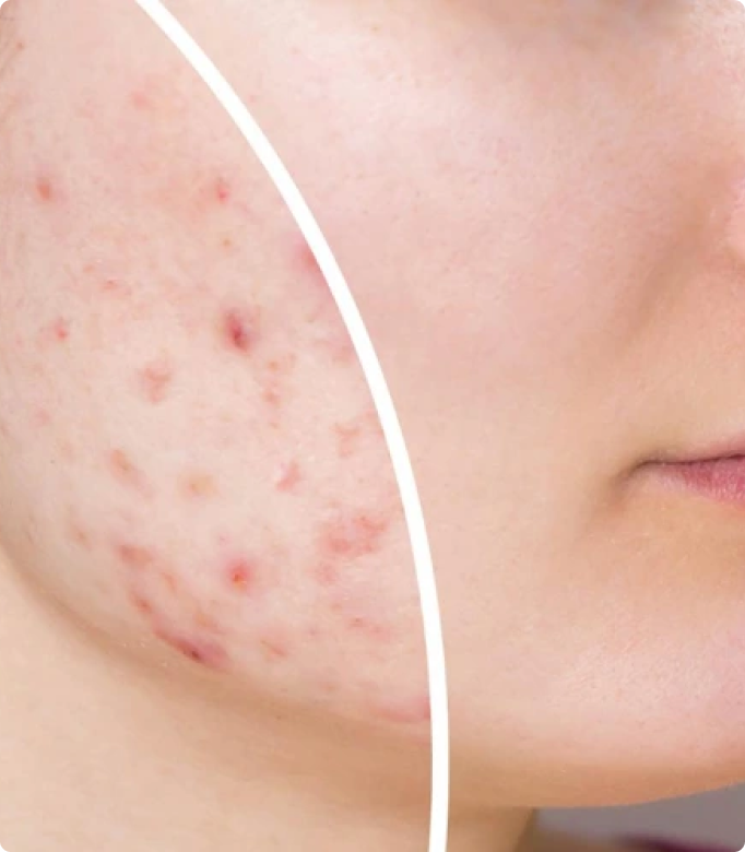 Before and after scar subcision treatment showing improved skin texture and reduced acne scars.