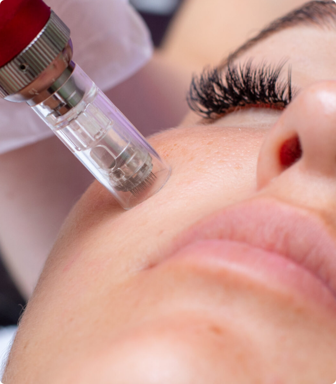 Microneedling treatment being performed on a woman's face for skin rejuvenation.