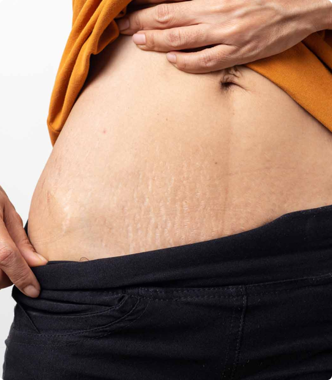 Stretch marks on a woman's side, showing areas in need of stretch marks removal treatment.