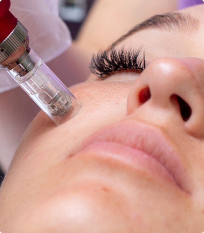 MNRF (Microneedling Radiofrequency) treatment being applied to a woman's face.