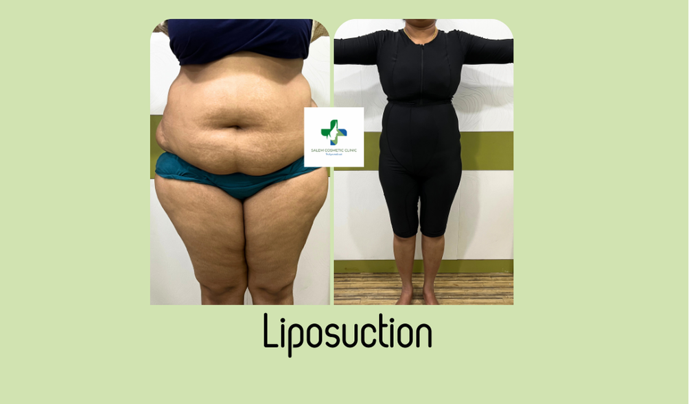Liposuction