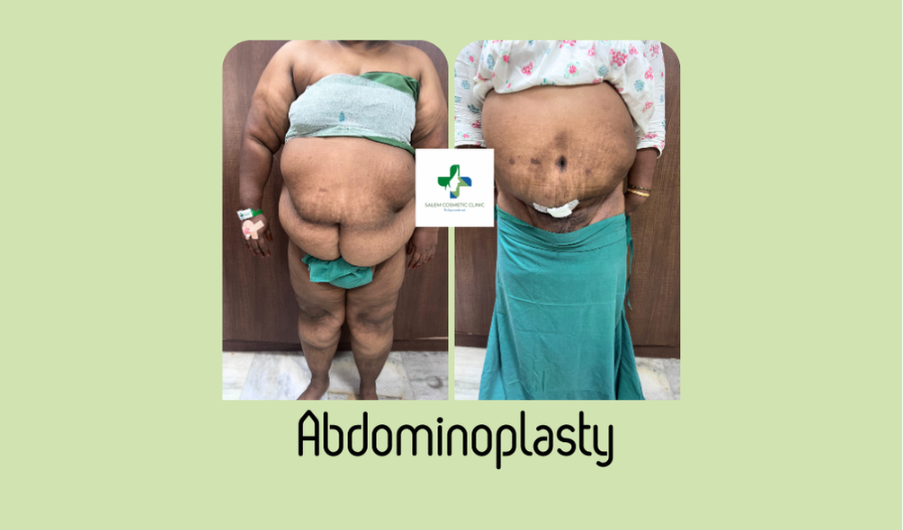 Abdominoplasty