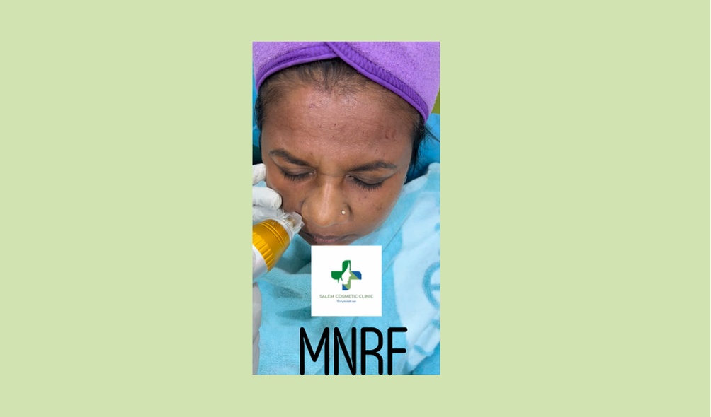 MNRF procedure