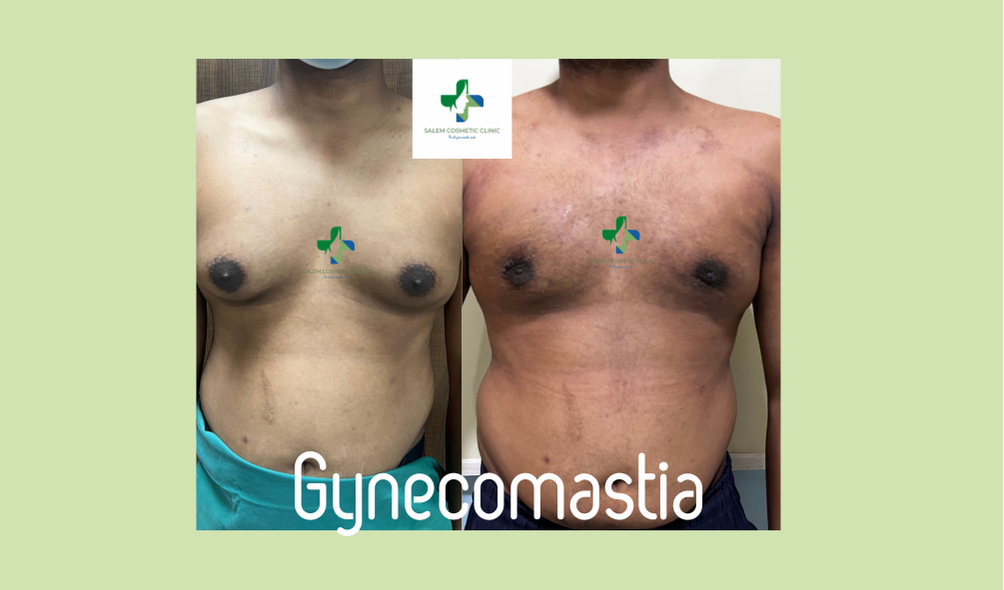 Gynecomastia