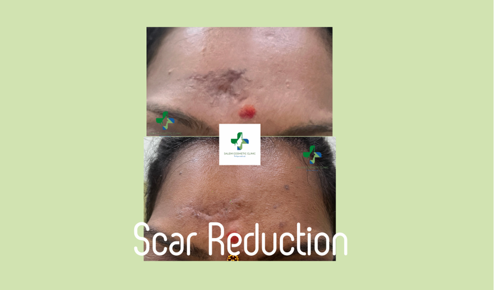 Scar reduction
