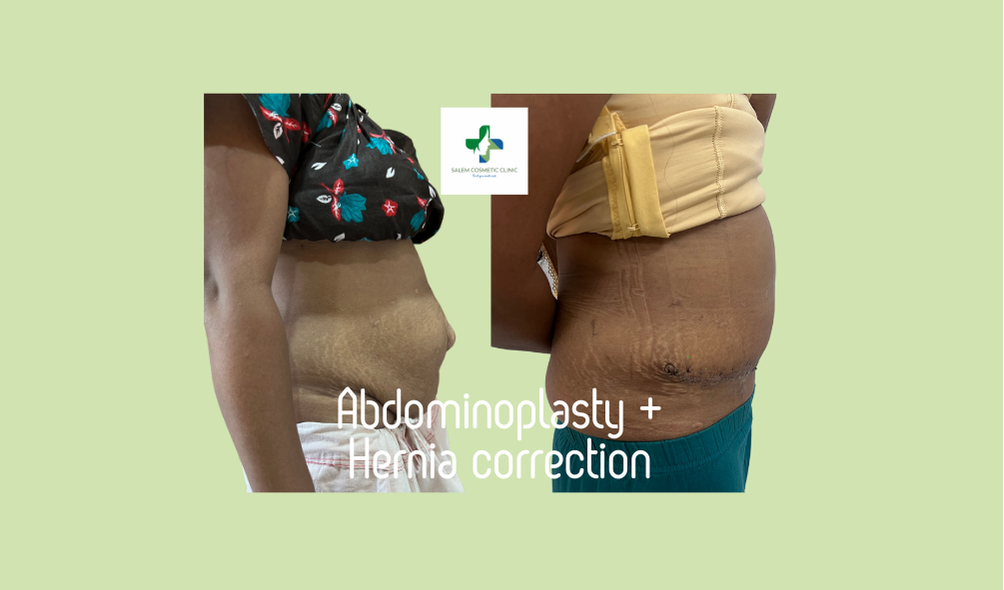 Abdominoplasty + Hernia Correction
