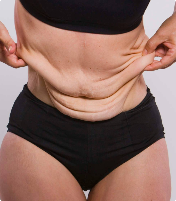 Post weight loss body lift procedure showing excess skin around the abdomen for contouring.