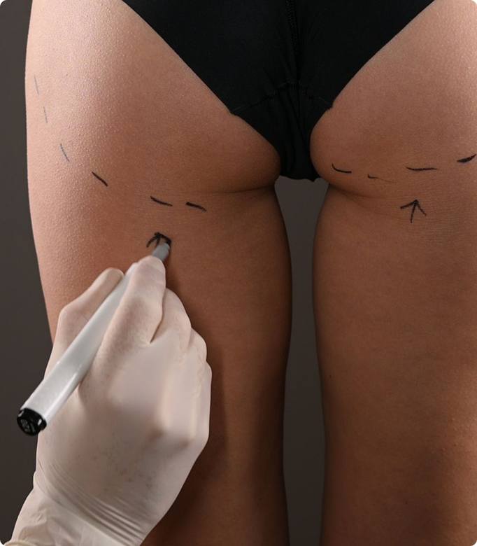 Gluteal augmentation by fat injection procedure with markings on the buttocks for fat transfer.