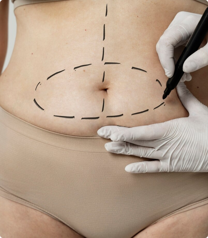Tummy_Tuck