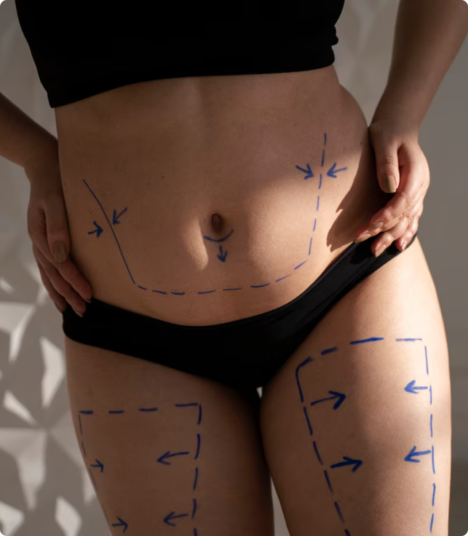 Liposuction procedure markings on a woman's abdomen and thighs for fat removal.