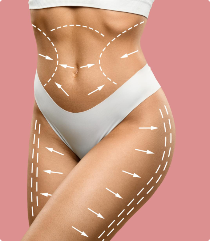 Body lift procedure markings on a woman's abdomen and thighs for body contouring.