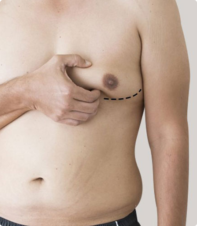 Male breast correction procedure with markings on a man’s chest for gynecomastia surgery.