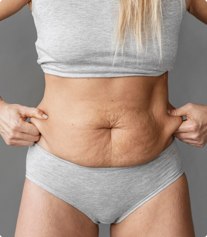 Mommy makeover procedure to address post-pregnancy changes with focus on abdominal area.