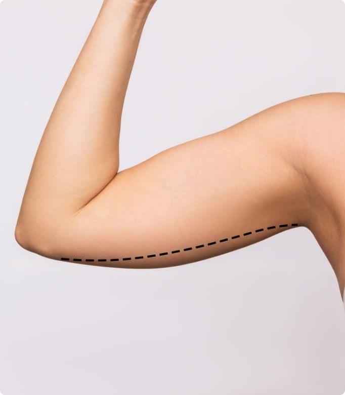 Arm lift procedure markings on a woman's arm for excess skin removal and contouring.